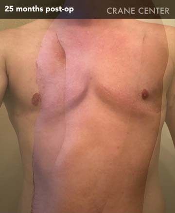 Top surgery scar — 6 months post-op