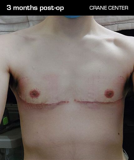 Top surgery scar — 3 months post-op