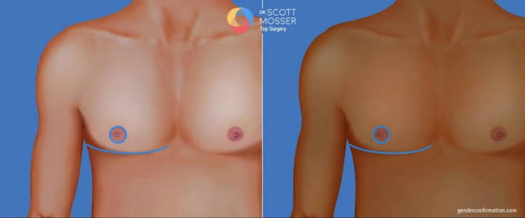 Top surgery final result
